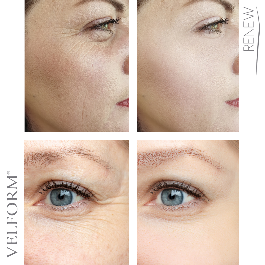 Patches Solúveis com Colagénio e Ácido Hialurónico para o Rosto